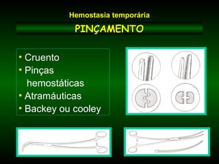 PINÇAMENTOPINÇAMENTO
• Cruento
• Pinças
hemostáticas
• Atramáuticas
• Backey ou cooley
Hemostasia temporária
 