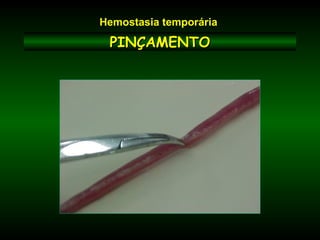 PINÇAMENTOPINÇAMENTO
Hemostasia temporária
 