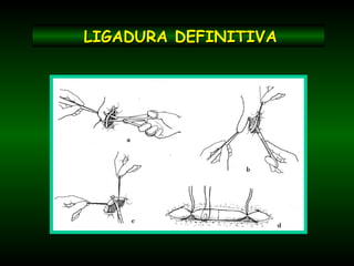 LIGADURA DEFINITIVALIGADURA DEFINITIVA
 