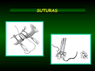 SUTURASSUTURAS
 