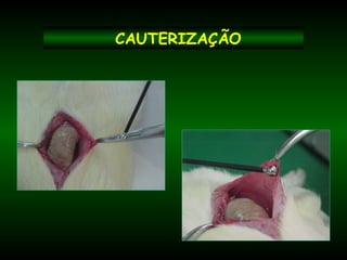 CAUTERIZAÇÃO
 