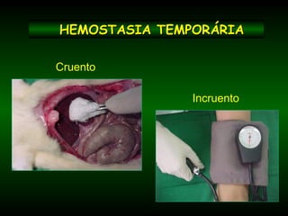 HEMOSTASIA TEMPORÁRIAHEMOSTASIA TEMPORÁRIA
Incruento
Cruento
 