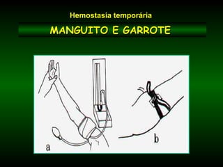 MANGUITO E GARROTEMANGUITO E GARROTE
Hemostasia temporária
 