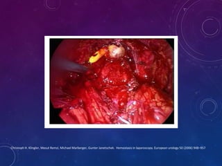Ooforectomía laparoscópica presentando las tijeras HARMONIC ACE®+7 con  hemostasia avanzada 
