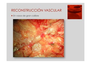 RECONSTRUCCIÓN VASCULAR
 En vasos de gran calibre
 