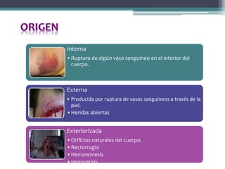 Interna
•Ruptura de algún vaso sanguíneo en el interior del
cuerpo.
Externa
• Producida por ruptura de vasos sanguíneos a través de la
piel.
•Heridas abiertas
Exteriorizada
•Orificios naturales del cuerpo.
•Rectorragia
•Hematemesis
•Hemoptisis
 