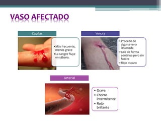 •Más frecuente,
menos grave
•La sangre fluye
en sábana.
Capilar
•Procede de
alguna vena
lesionada
•sale de forma
continua pero sin
fuerza
•Rojo oscuro
Venosa
• Grave
• Chorro
intermitente
• Rojo
brillante
Arterial
 