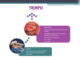 Primaria
Producida intra operatoriamente.
Consecuencia de algún tipo de
laceración.
Secundaria
Ocurre después de 24 horas de una
cirugía.
Asociada a presencia de cuerpos
extraños en alveolos.
Hemorragia en napa agresiva
Gran coágulo
Saliva teñida
 