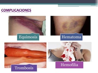 Equimosis Hematoma
Trombosis
Hemofilia
 