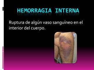 HEMORRAGIA INTERNA
Ruptura de algún vaso sanguíneo en el
interior del cuerpo.

 