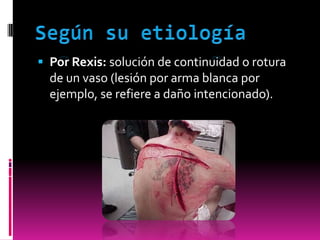  Por Rexis: solución de continuidad o rotura
de un vaso (lesión por arma blanca por
ejemplo, se refiere a daño intencionado).

 