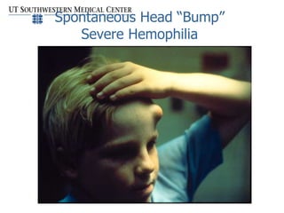 Spontaneous Head “Bump”
Severe Hemophilia
 