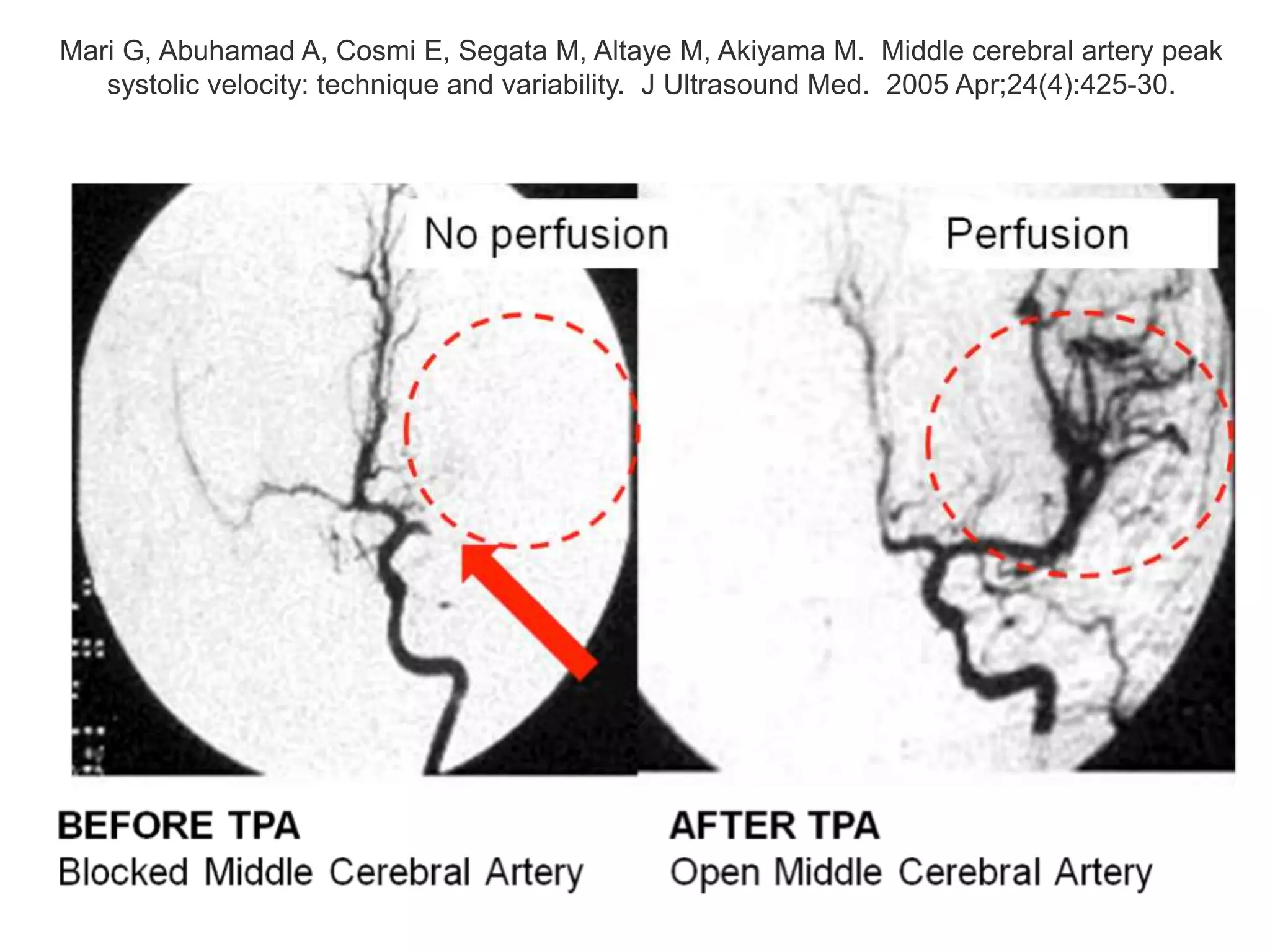 Mari G, Abuhamad A, Cosmi E, Segata M, Altaye M, Akiyama M. Middle cerebral artery peak
systolic velocity: technique and variability. J Ultrasound Med. 2005 Apr;24(4):425-30.
 