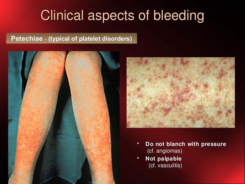 Hemostasis Disorders