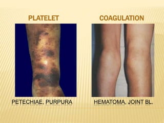 PLATELET COAGULATION 
PETECHIAE, PURPURA HEMATOMA, JOINT BL. 
 
