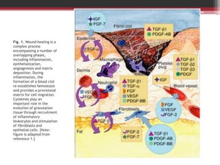 Fig. 1. Wound healing is a
complex process
encompassing a number of
overlapping phases,
including inflammation,
epithelialization,
angiogenesis and matrix
deposition. During
inflammation, the
formation of a blood clot
re-establishes hemostasis
and provides a provisional
matrix for cell migration.
Cytokines play an
important role in the
evolution of granulation
tissue through recruitment
of inflammatory
leukocytes and stimulation
of fibroblasts and
epithelial cells. [Note:
figure is adapted from
reference 1.]
 