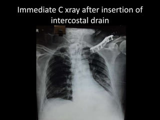 Immediate C xray after insertion of
intercostal drain
 