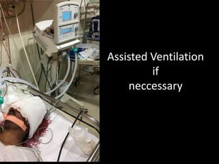 Assisted Ventilation
if
neccessary
 
