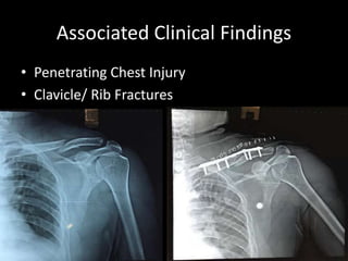 Associated Clinical Findings
• Penetrating Chest Injury
• Clavicle/ Rib Fractures
 
