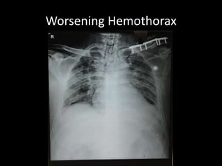 Worsening Hemothorax
 