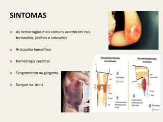 SINTOMAS
o As hemorragias mais comuns acontecem nos
  tornozelos, joelhos e cotovelos

o Artropatia hemofílica

o Hemorragia cerebral

o Sangramento na garganta

o Sangue na urina
 
