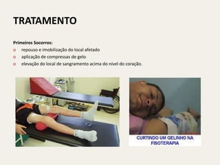 TRATAMENTO
Primeiros Socorros:
o repouso e imobilização do local afetado
o aplicação de compressas de gelo
o elevação do local de sangramento acima do nível do coração.
 