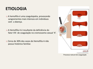 ETIOLOGIA
o A hemofilia é uma coagulopatia, provocando
  sangramentos mais intensos em indivíduos
  com a doença.


o A Hemofilia A é resultante da deficiência do
  fator VIII de coagulação no cromossomo sexual ‘X’.


o Cerca de 30% dos casos de Hemofilia A não
  possui histórico familiar.



                                                       Processo natural de coagulação
 