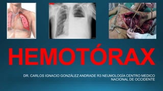 HEMOTÓRAX
DR. CARLOS IGNACIO GONZÁLEZ ANDRADE R3 NEUMOLOGÍA CENTRO MEDICO
NACIONAL DE OCCIDENTE
 