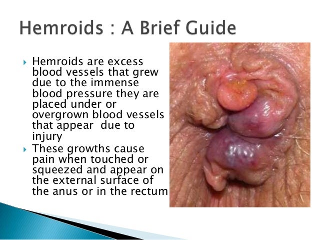 Hemorrhoids Natural Cure Diet Hemorrhoids Natural Cure Diet