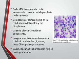 • En la MO, la celularidad esta
aumentada con marcada hiperplasia
de la serie roja.

• Se observa el asincronismo en la
maduración del núcleo y del
citoplasma.

• La serie blanca también es
exuberante.

• Los granulocitos

muestran meta
mielocitos y bandas gigantes,
neutrófilos polisegmantados.

• Los megacariocitos presentan núcleo
polisegmentado

 