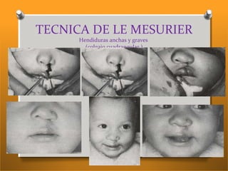 TECNICA DE LE MESURIER
Hendiduras anchas y graves
(colgajo cuadrangular.)
 