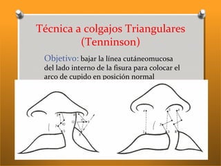 Técnica a colgajos Triangulares
(Tenninson)
Objetivo: bajar la línea cutáneomucosa
del lado interno de la fisura para colocar el
arco de cupido en posición normal
 