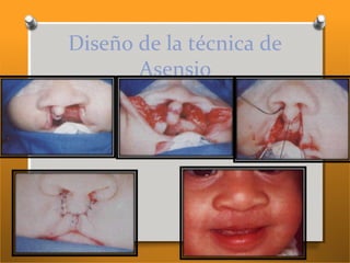 Diseño de la técnica de
Asensio
 