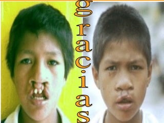 Hendidura labial leip