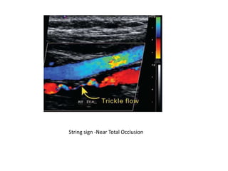 carotid doppler u/s Radiology | PPTX