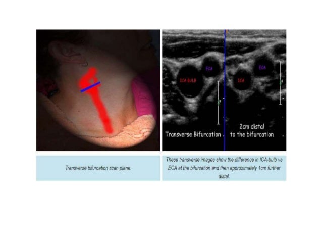 carotid doppler radiology