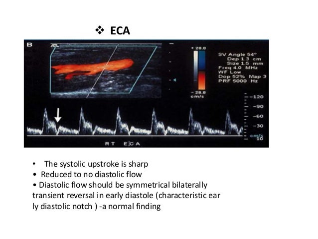 carotid doppler results explained carotid doppler results explained
