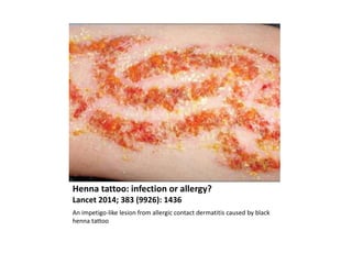 Henna tattoo: infection or allergy?
Lancet 2014; 383 (9926): 1436
An impetigo-like lesion from allergic contact dermatitis caused by black
henna tattoo
 