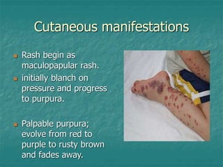 Hsp Rash Examples Henoch-schonlein purpura.ppt