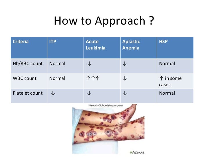 Image result for henoch schonlein purpura how to approach"