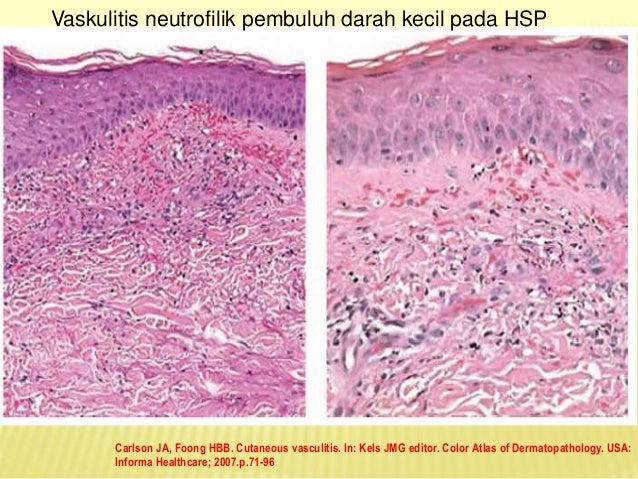 Immunopathogenesis Leukocytoclastic Vasculitis in Henoch 