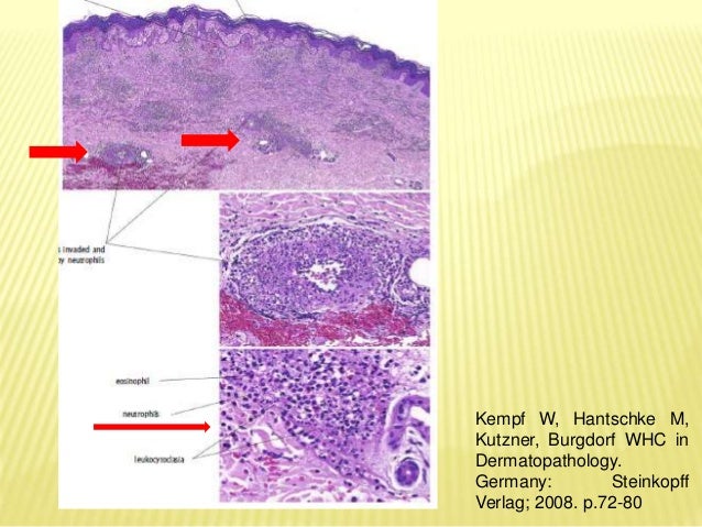Immunopathogenesis Leukocytoclastic Vasculitis in Henoch 