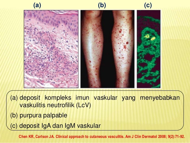 Immunopathogenesis Leukocytoclastic Vasculitis in Henoch 