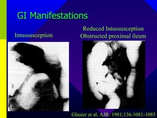 GI Manifestations Intussusception Reduced Intussusception Obstructed proximal ileum Glasier et al. AJR: 1981;136:1081-1085 