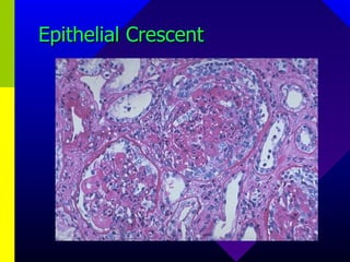 Epithelial Crescent 