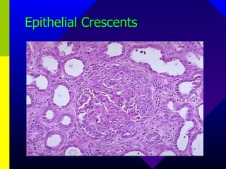 Epithelial Crescents 