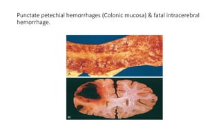 Punctate petechial hemorrhages (Colonic mucosa) & fatal intracerebral
hemorrhage.
 