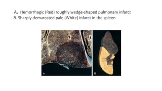 A. Hemorrhagic (Red) roughly wedge-shaped pulmonary infarct
B. Sharply demarcated pale (White) infarct in the spleen
 