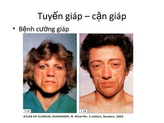 Tuyến giáp – cận giáp 
• Bệnh cường giáp 
ATLAS OF CLINICAL DIAGNOSIS. M. Afzal Mir, 2 edition, Sauders, 2003 
 