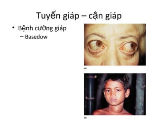 Tuyến giáp – cận giáp 
• Bệnh cường giáp 
– Basedow 
 